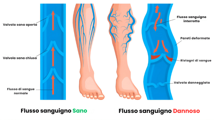 Calze a compressione